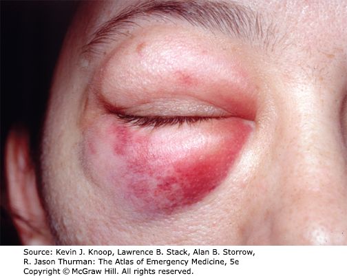 Medial wall fracture &mdash; Periorbital ecchymosis and swelling