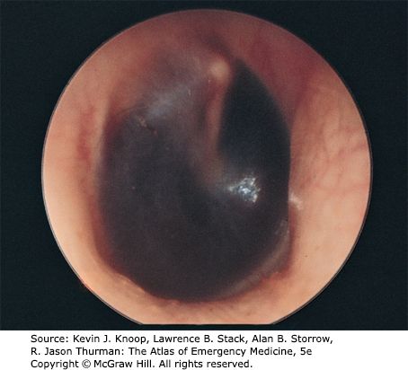 Hemotympanum &mdash; Blood behind the tympanic membrane
