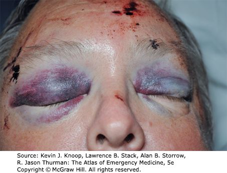 Raccoon eyes &mdash; Periorbital ecchymosis, without direct orbital trauma