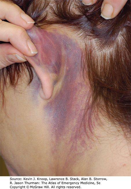 Battle sign &mdash; Retroauricular ecchymosis over the mastoid