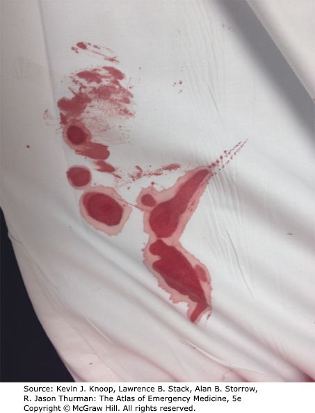 Halo (double ring) sign &mdash; Otorrhea on a bedsheet: inner ring of blood, outer ring of cerebrospinal fluid