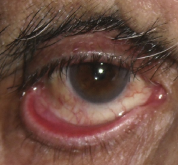 Ectropion &mdash; Lid margin rolled OUT, exposing the inner surface