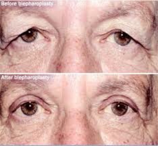 Dermatochalasis &mdash; Excess folds of upper lid skin hanging over the lashes