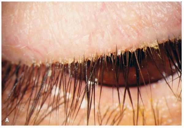 Blepharitis / Meibomitis &mdash; Crusting and collarettes at the base of the lashes