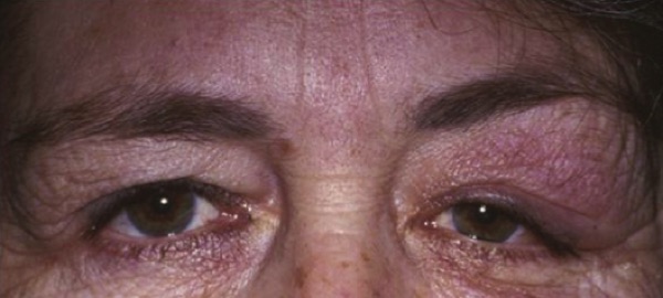 Dacryoadenitis &mdash; Swelling of the outer third of the UPPER lid