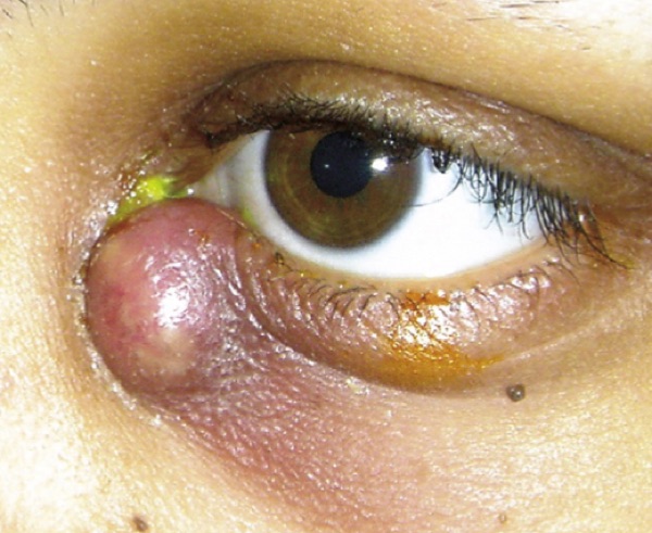Dacryocystitis &mdash; Swelling BELOW the medial canthal tendon, pus from the punctum