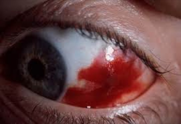 Subconjunctival hemorrhage &mdash; Flat sheet of blood under the conjunctiva, cornea clear