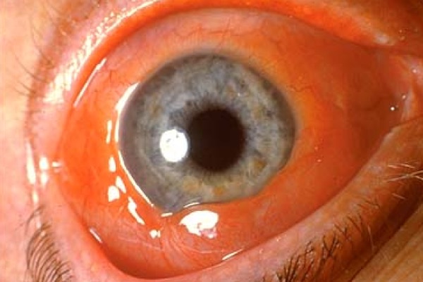 Chemosis &mdash; The conjunctiva itself swollen and ballooning
