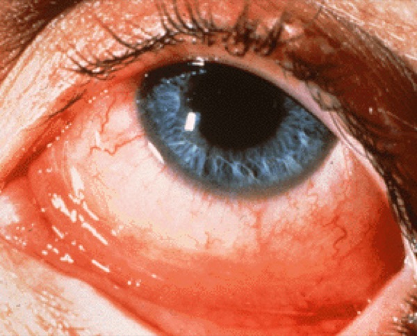 Allergic conjunctivitis &mdash; Cobblestone papillae under the lid, and no node