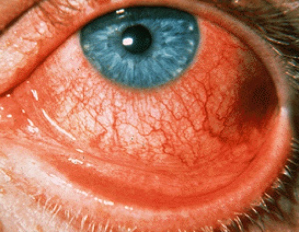 Viral conjunctivitis &mdash; Follicles plus watery discharge; the node is tender