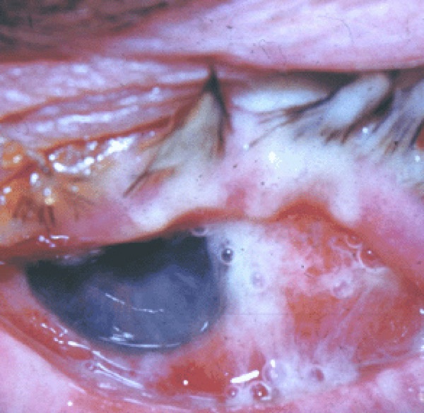 Bacterial conjunctivitis &mdash; Papillae with thick yellow discharge gluing the lashes