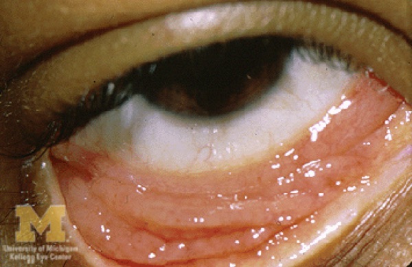 Chlamydial conjunctivitis &mdash; adult inclusion &mdash; Follicles persisting beyond a month