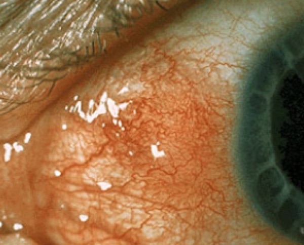 Episcleritis &mdash; Sectoral redness; the vessels move when swept