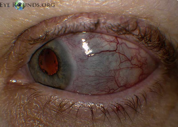 Scleritis &mdash; Deep violaceous hue; the vessels do NOT move