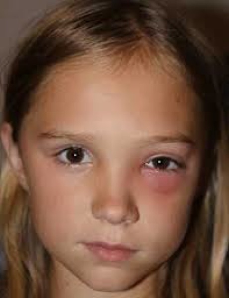 Pre-septal (periorbital) cellulitis &mdash; Lids swollen but THE EYE ITSELF IS WHITE