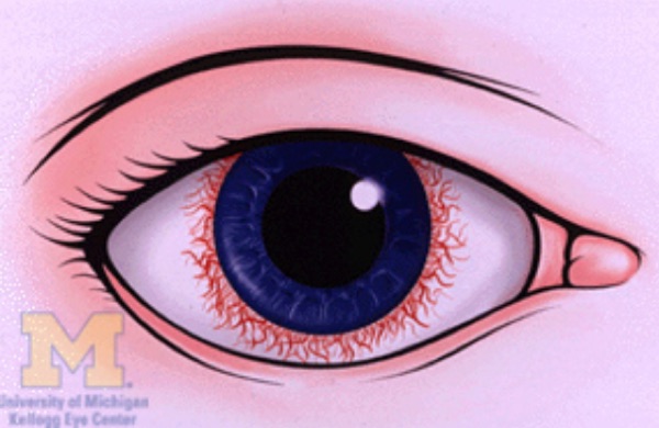 Ciliary flush &mdash; a ring of vessels radiating from the limbus around the cornea. This is the finding that rules OUT simple conjunctivitis.