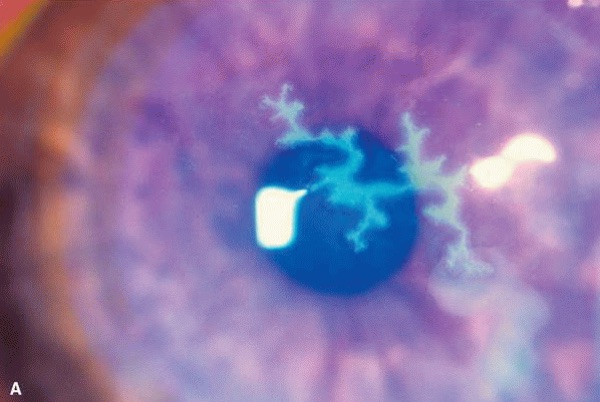Herpes simplex keratitis &mdash; Branching dendrite with TERMINAL END BULBS on fluorescein