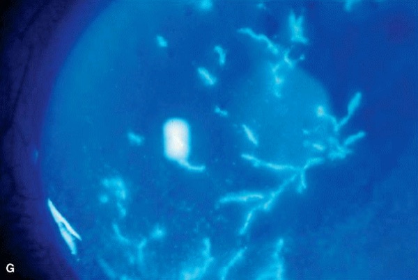 Herpes zoster keratitis &mdash; Pseudodendrite without end bulbs, in a dermatomal rash