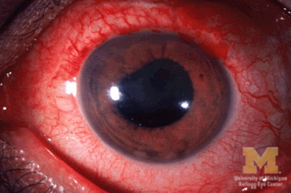 Anterior uveitis (iritis, iridocyclitis) &mdash; Ciliary flush with an irregular pupil