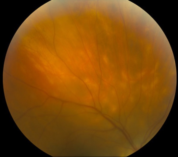 Posterior uveitis (choroiditis, retinitis) &mdash; Vitreous haze obscuring the retinal detail