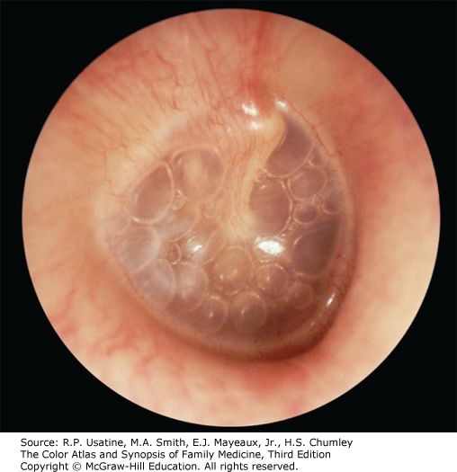 Otitis media with effusion, from the lecture slides.