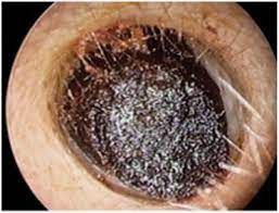 Cerumen impaction, from the lecture slides.