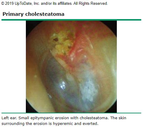 Cholesteatoma, from the lecture slides.