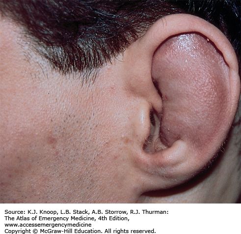 Hematoma of the external ear, from the lecture slides.