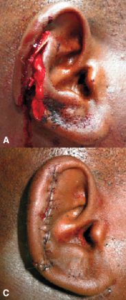 Lacerations and avulsion, from the lecture slides.