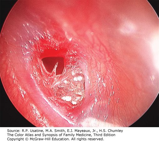 Tympanic membrane perforation, from the lecture slides.