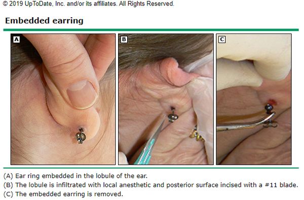Foreign body of the auricle, from the lecture slides.