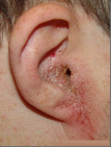 Otitis externa, from the lecture slides.