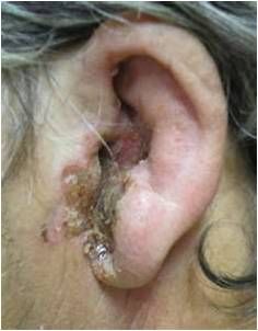 Malignant otitis externa, from the lecture slides.