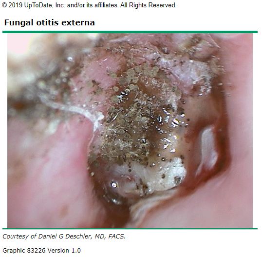 Otomycosis, from the lecture slides.