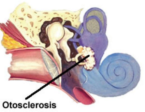 Otosclerosis, from the lecture slides.