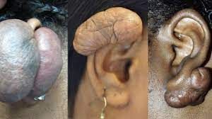 Keloid of the ear, from the lecture slides.