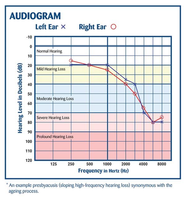Presbycusis, from the lecture slides.