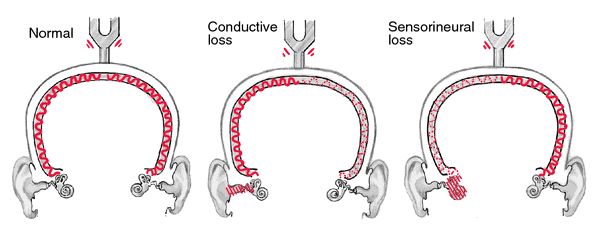 Conductive hearing loss, from the lecture slides.