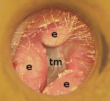 Exostosis, from the lecture slides.