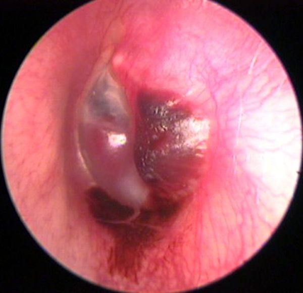 Glomus tumor, from the lecture slides.