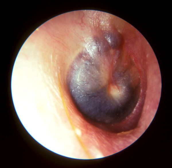 Barotrauma, from the lecture slides.