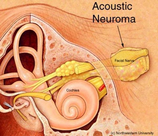 Acoustic neuroma, from the lecture slides.