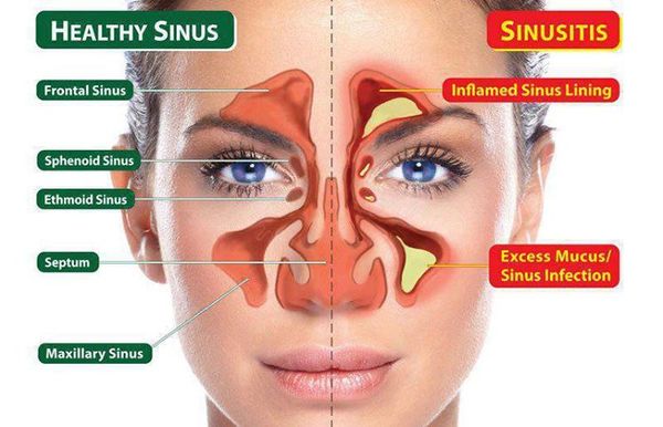 Acute sinusitis (rhinosinusitis), from the lecture slides.