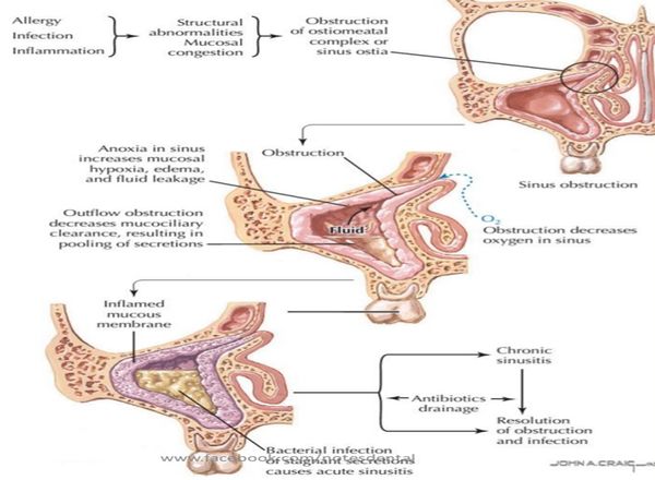 Bacterial sinusitis   the features that suggest it, from the lecture slides.