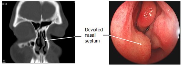 Deviated septum, from the lecture slides.