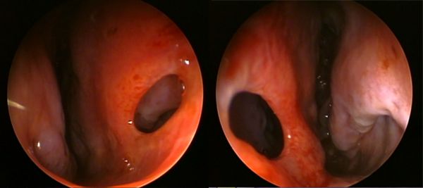 Perforated septum, from the lecture slides.