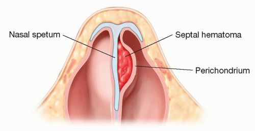 Septal hematoma, from the lecture slides.