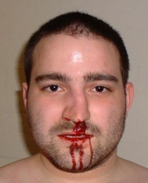 Nasal fracture, from the lecture slides.
