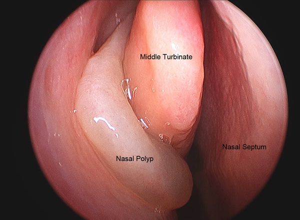 Nasal polyps, from the lecture slides.