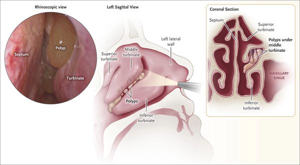 Allergic rhinitis, from the lecture slides.